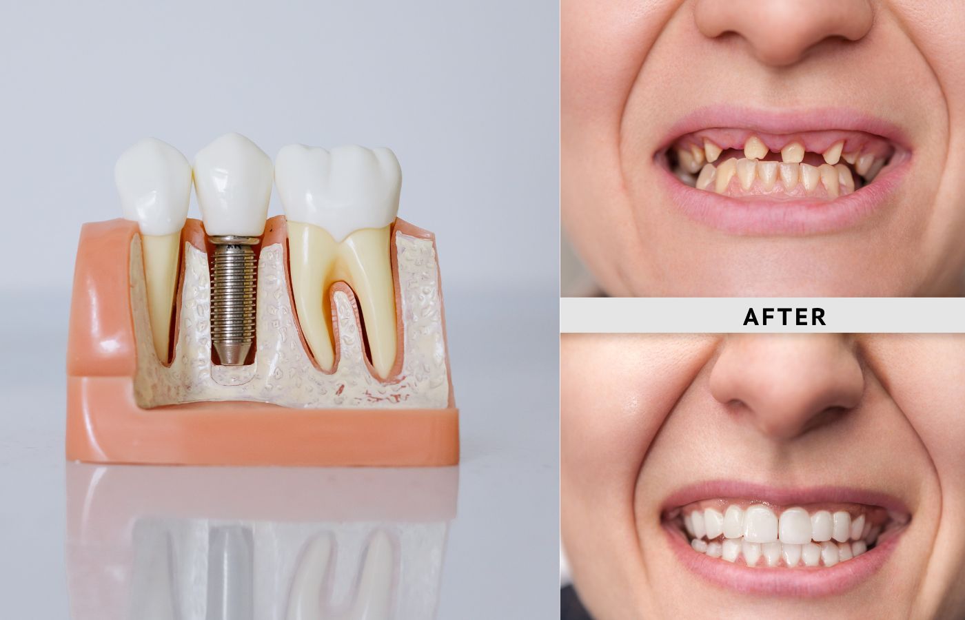 Dental implant in Bellandur