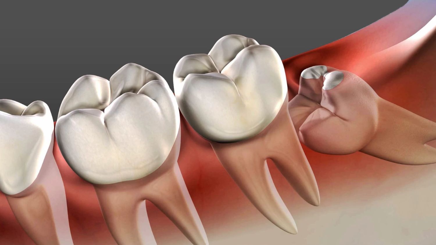 Wisdom tooth removal in Bellandur
