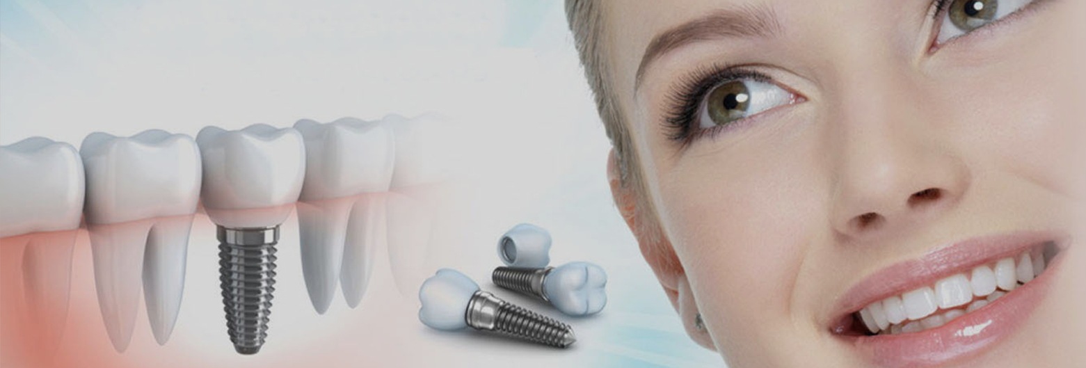 Dental implants clinic Kasavanahalli Bangalore
