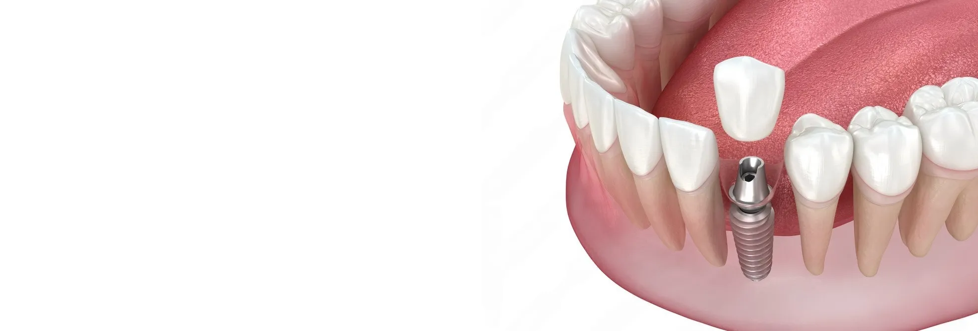 Dentist near Rainbow Drive Sarjapur Bangalore