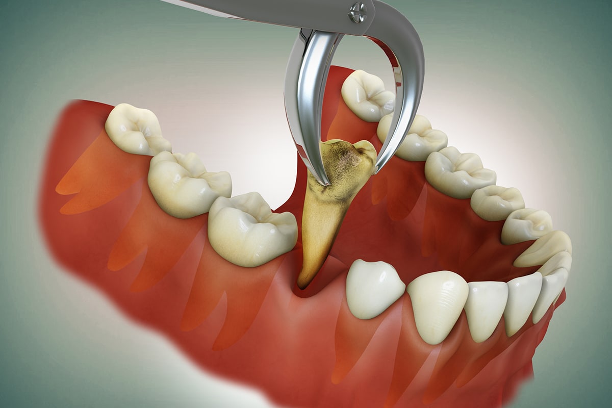 Tooth extraction cost Kasavanahalli Bangalore