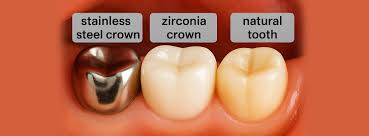 Zirconia crowns and bridges Bellandur Bangalore