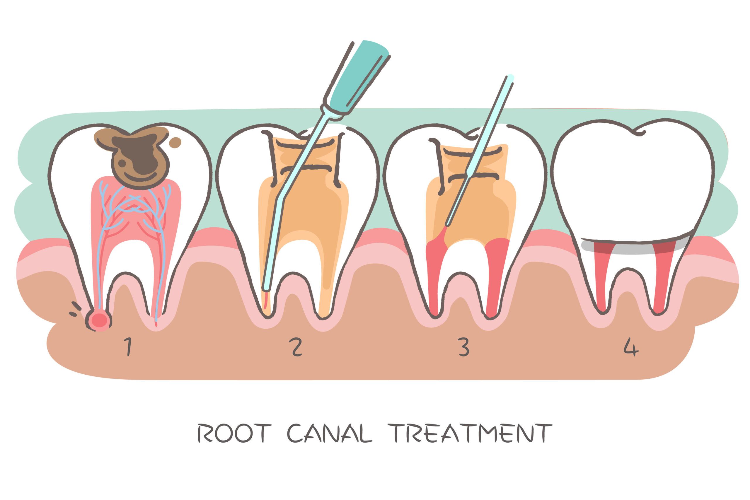 Post-treatment care for root canal in Bangalore